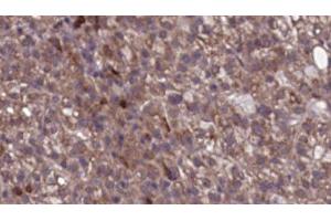 ABIN6276742 at 1/100 staining Human liver cancer tissue by IHC-P. (SCARB1 anticorps  (Internal Region))