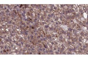 ABIN6276742 at 1/100 staining Human liver cancer tissue by IHC-P.