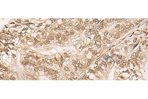 Immunohistochemistry of paraffin-embedded Human gastric cancer tissue using WEE1 Polyclonal Antibody at dilution of 1:35(x200) (WEE1 anticorps)