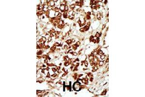 Formalin-fixed and paraffin-embedded human hepatocellular carcinoma tissue reacted with MLKLAK polyclonal antibody  , which was peroxidase-conjugated to the secondary antibody, followed by AEC staining. (ZAK anticorps  (Internal Region))