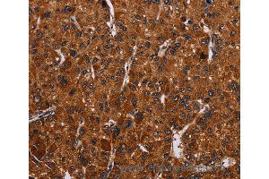 Immunohistochemistry of Human thyroid cancer using RTN4R Polyclonal Antibody at dilution of 1:50 (RTN4R anticorps)