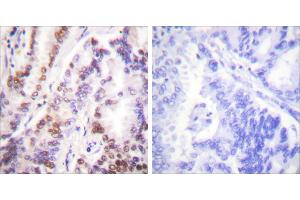 Peptide - +Immunohistochemical analysis of paraffin-embedded human lung carcinoma tissue using HDAC9 antibody (#C0228). (HDAC9 anticorps)