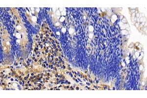 Detection of BCL2L11 in Human Colorectal cancer Tissue using Polyclonal Antibody to Bcl2 Like Protein 11 (BCL2L11)