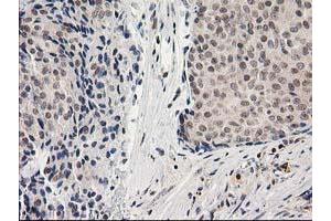 Immunohistochemical staining of paraffin-embedded Adenocarcinoma of Human breast tissue using anti-ADH1B mouse monoclonal antibody. (ADH1B anticorps)