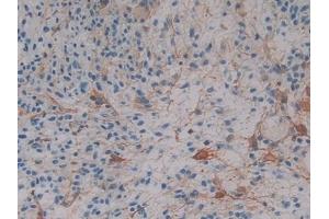 Detection of CRYaB in Human Glioma Tissue using Polyclonal Antibody to Crystallin Alpha B (CRYaB)