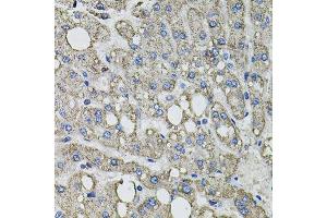 Immunohistochemistry of paraffin-embedded human liver injury using GFPT1 antibody. (GFPT1 anticorps  (AA 1-150))