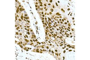 Immunohistochemistry of paraffin-embedded human esophageal cancer using DNA-PKcs Rabbit mAb (ABIN7269665) at dilution of 1:100 (40x lens). (PRKDC anticorps)
