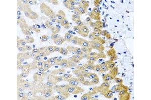 Immunohistochemistry of paraffin-embedded Human liver damage using M6PR Polyclonal Antibody at dilution of 1:100 (40x lens). (M6PR anticorps)