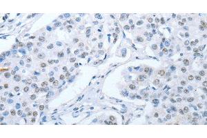 Immunohistochemistry of paraffin-embedded Human breast cancer tissue using ARHGEF2 Polyclonal Antibody at dilution 1:30 (ARHGEF2 anticorps)