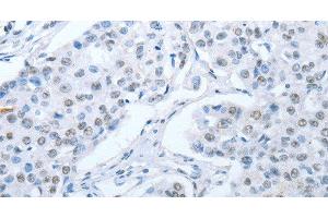 Immunohistochemistry of paraffin-embedded Human breast cancer tissue using ARHGEF2 Polyclonal Antibody at dilution 1:30