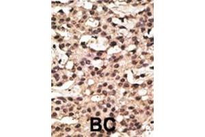 Formalin-fixed and paraffin-embedded human cancer tissue reacted with the primary antibody, which was peroxidase-conjugated to the secondary antibody, followed by DAB staining. (ATG9A anticorps  (AA 252-281))