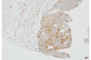 IHC-P Image Immunohistochemical analysis of paraffin-embedded OVCA xenograft, using SUOX, antibody at 1:100 dilution.