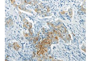 The image on the left is immunohistochemistry of paraffin-embedded Human cervical cancer tissue using ABIN7193069(WNT8B Antibody) at dilution 1/20, on the right is treated with synthetic peptide. (WNT8B anticorps)