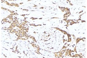 ABIN6275697 at 1/100 staining Human lung cancer tissue by IHC-P. (SLC30A4 anticorps  (Internal Region))