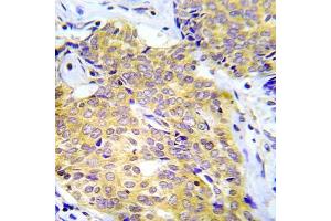 Immunohistochemical analysis of paraffin- embedded human lung adenocarcinoma tissue using CrkL (Ab-207) Antibody (E022071). (CrkL anticorps)