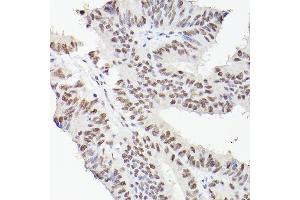 Immunohistochemistry of paraffin-embedded human colon carcinoma using LEO1 Rabbit pAb (ABIN6133790, ABIN6143141 and ABIN7101832) at dilution of 1:100 (40x lens).