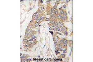 Formalin-fixed and paraffin-embedded human breast carcinoma tissue reacted with CASC3 Antibody , which was peroxidase-conjugated to the secondary antibody, followed by DAB staining.