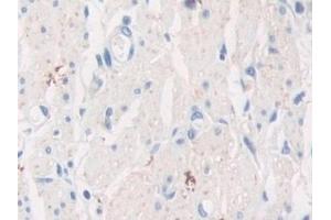 Detection of TPPP in Human Stomach cancer Tissue using Polyclonal Antibody to Tubulin Polymerization Promoting Protein (TPPP) (Tppp anticorps  (AA 8-210))