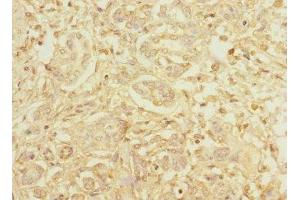 Immunohistochemistry of paraffin-embedded human pancreatic cancer using ABIN7155071 at dilution of 1:100 (Hephaestin anticorps  (AA 300-580))