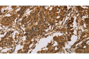 Immunohistochemistry of paraffin-embedded Human gastric cancer tissue using IL19 Polyclonal Antibody at dilution 1:40
