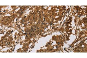 Immunohistochemistry of paraffin-embedded Human gastric cancer tissue using IL19 Polyclonal Antibody at dilution 1:40 (IL-19 anticorps)
