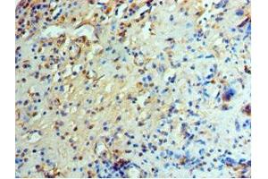Immunohistochemistry of paraffin-embedded human prostate cancer using ABIN7151466 at dilution of 1:100 (GCN2 anticorps  (AA 1-300))