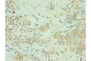 Immunohistochemistry of paraffin-embedded human breast cancer using ABIN7157738 at dilution of 1:100 (SPINT1 anticorps  (AA 250-529))