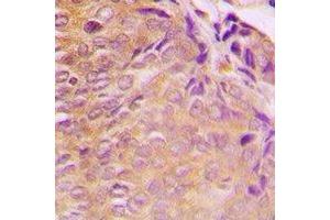 Immunohistochemical analysis of GRB10 staining in human breast cancer formalin fixed paraffin embedded tissue section.