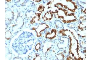 FFPE human renal cell carcinoma tested with MFGE8 antibody (MFG-06) (MFGE8 anticorps)