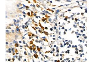 Phospho-RUNX2 (Ser319) Antibody at 1/100 staining Human lung cancer by IHC-P.