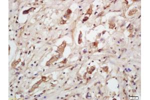 Formalin-fixed and paraffin embedded human lung carcinoma labeled with Rabbit Anti-IGFBP7 Polyclonal Antibody, Unconjugated  at 1:200 followed by conjugation to the secondary antibody and DAB staining (IGFBP7 anticorps  (AA 131-230))