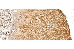 Immunohistochemistry of paraffin-embedded Human esophagus cancer tissue using FAM155B Polyclonal Antibody at dilution of 1:30(x200) (FAM155B anticorps)