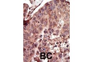 Formalin-fixed and paraffin-embedded human cancer tissue reacted with the primary antibody, which was peroxidase-conjugated to the secondary antibody, followed by AEC staining.
