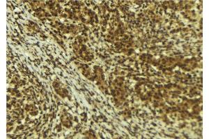 ABIN6273995 at 1/100 staining Human breast cancer tissue by IHC-P. (BRD4 anticorps  (N-Term))