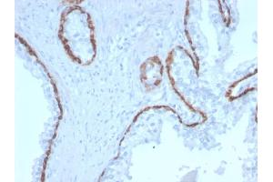 Formalin-fixed, paraffin-embedded human Prostate Carcinoma stained with Cytokeratin 15 Mouse Monoclonal Antibody (KRT15/2958).