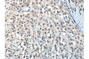 The image on the left is immunohistochemistry of paraffin-embedded Human esophagus cancer tissue using ABIN7128286(AGBL3 Antibody) at dilution 1/25, on the right is treated with fusion protein. (AGBL3 anticorps)