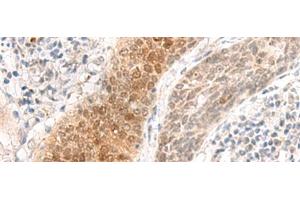Immunohistochemistry of paraffin-embedded Human esophagus cancer tissue using GHDC Polyclonal Antibody at dilution of 1:90(x200) (GHDC anticorps)