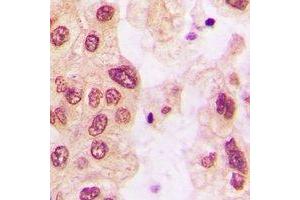 Immunohistochemical analysis of HSP27 (pS82) staining in human lung cancer formalin fixed paraffin embedded tissue section.