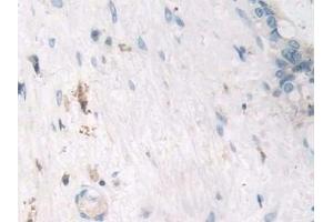 Detection of TNFa in Human Bile duct cancer Tissue using Polyclonal Antibody to Tumor Necrosis Factor Alpha (TNFa) (TNF alpha anticorps  (AA 77-233))