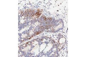 Immunohistochemical analysis of paraffin-embedded Human colon carcinoma tissue using (ABIN389547 and ABIN2839591) performed on the Leica® BOND RXm. (CREB1 anticorps  (pSer133))