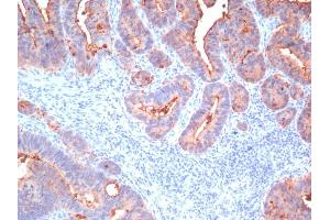Formalin-fixed, paraffin-embedded human Colon Carcinoma stained with CEA, pan Mouse Monoclonal Antibody (Cocktail) (CEACAM5 anticorps)