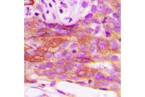 Immunohistochemical analysis of HSL staining in human breast cancer formalin fixed paraffin embedded tissue section.
