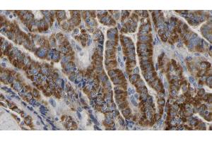 ABIN6267173 at 1/100 staining Human thyroid cancer tissue by IHC-P.