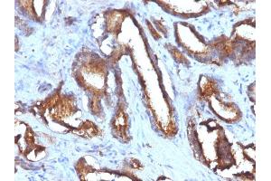 Formalin-fixed, paraffin-embedded human Prostate Carcinoma stained with CD63 Monoclonal Antibody (NKI/C3 + LAMP3/968) (CD63 anticorps)