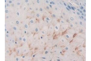 Detection of BCAM in Human Stomach cancer Tissue using Polyclonal Antibody to Basal Cell Adhesion Molecule (BCAM)