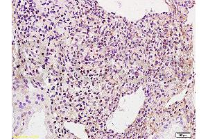 Formalin-fixed and human kidney carcinoma tissue labeled with Anti-phospho-BACH1/BRIP1(Ser990) Polyclonal Antibody, Unconjugated  at 1:200 followed by conjugation to the secondary antibody and DAB staining