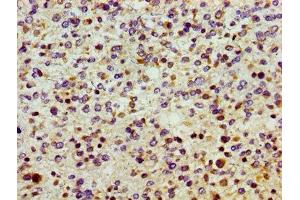 Immunohistochemistry of paraffin-embedded human glioma using ABIN7170545 at dilution of 1:100