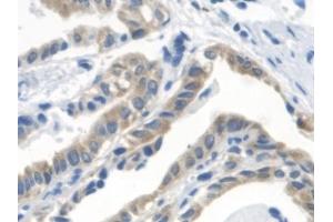 Detection of OXCT1 in Human Thyroid cancer Tissue using Polyclonal Antibody to 3-Oxoacid Coenzyme A Transferase 1 (OXCT1) (OXCT1 anticorps  (AA 40-489))