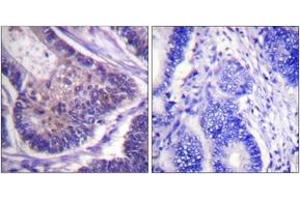 Immunohistochemistry analysis of paraffin-embedded human colon carcinoma tissue, using eIF4B (Ab-422) Antibody. (EIF4B anticorps  (AA 388-437))