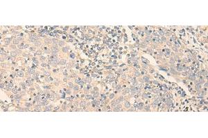 Immunohistochemistry of paraffin-embedded Human cervical cancer tissue using GCDH Polyclonal Antibody at dilution of 1:30(x200) (GCDH anticorps)